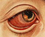 Болезнь глаз лечение ирит thumbnail