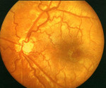 Гипоплазия глаз у новорожденных лечение thumbnail