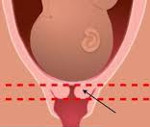 Истмико цервикальная недостаточность во время беременности лечение thumbnail