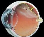Отслойка сетчатки глаза патогенез thumbnail