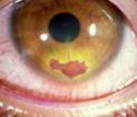 Вирусное воспаление роговицы глаза thumbnail