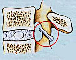 Спондилоартроз коленного сустава лечение thumbnail