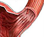 Желудочно пищеводный разрыв геморрагический синдром thumbnail