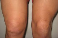 Артрит коленного сустава: что такое, симптомы, методы диагностики и лечения thumbnail