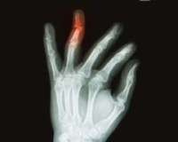 Открытый перелом пальца руки у ребенка thumbnail