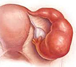 Киста левого яичника гидросальпинкс слева thumbnail