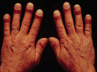 Паранеопластические синдромы при раке щитовидной железы thumbnail