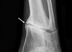 Ложный сустав лучевой кости после перелома thumbnail