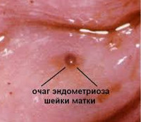 Как можно вылечить эндометриоз шейки матки thumbnail