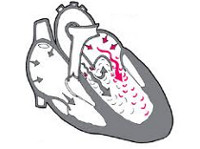 Как изменяется артериальное давление при аортальной недостаточности thumbnail
