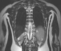 Диастематомиелия синдром фиксированного спинного мозга thumbnail