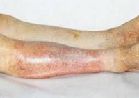 Облитерирующий атеросклероз артерий нижних конечностей и его лечение thumbnail