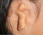 Аномалия развития ушной раковины код мкб thumbnail