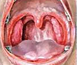 Анализы при катаральной ангине thumbnail