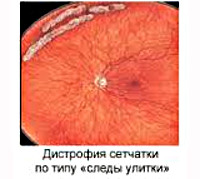 У ребенка периферическая дистрофия сетчатки глаза thumbnail