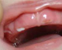 Порядок прорезывания зубов и симптомы и лечение thumbnail