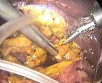 Перитонит после операции по удалению желчного пузыря thumbnail
