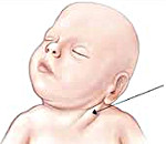 Кривошея у ребенка и головные боли thumbnail