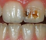 Болезни твердых тканей зуба некариозного происхождения thumbnail