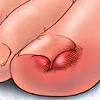 Вросший ноготь на большом пальце ноги лечение в одинцово thumbnail