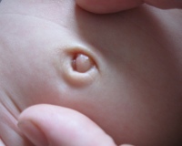 Пупок у новорожденных код мкб thumbnail