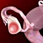 Кистома правого яичника в менопаузе thumbnail