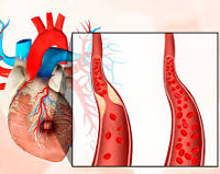 Безболевая форма инфаркта миокарда thumbnail