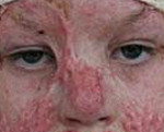Заболевания наружного носа ожог отморожение травмы thumbnail