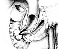 Опухоль большого сосочка поджелудочной железы thumbnail