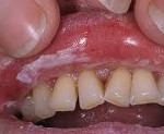 Кандидоза слизистых оболочек полости рта лечение thumbnail