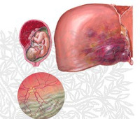 Хелп синдром при беременности смертность thumbnail