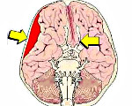 Что предполагает синдром сдавления головного мозга thumbnail