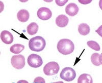 Серповидная анемия анизоцитоз гемоглобинопатии thumbnail