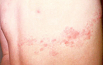 Медицина кожные заболевания лишаи thumbnail