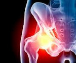 Симптомы артрита коленного и тазобедренного сустава thumbnail