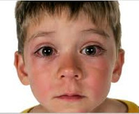 Поллиноз глаз у детей лечение thumbnail