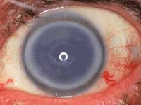 Эндотелиальная дистрофия роговицы глаза thumbnail