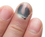 Палец под ногтем гематома thumbnail