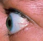 Отек глаз эндокринная офтальмопатия thumbnail