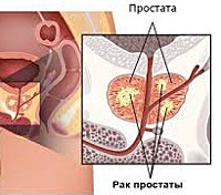 Гормонорезистентный рак предстательной железы лечение thumbnail