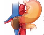Синдром верхней брыжеечной артерии мкб thumbnail