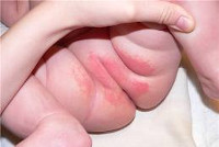 Что вызывает дерматит у детей thumbnail
