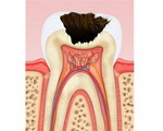 Что такое лечение зуба по глубокому кариесу thumbnail