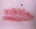 Лечение хронического кандидоза кожи thumbnail