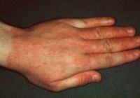 Контактный дерматит тип аллергической реакции thumbnail