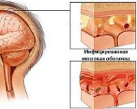 Инфекционные болезни с менингеальным синдромом thumbnail