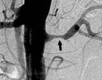 Стеноз почечных артерий гипертония лечение thumbnail