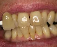 Пигментированный зуб лечение thumbnail