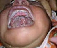 Молочница у детей симптомы молочницы у ребенка thumbnail