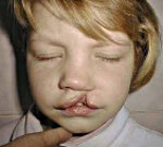 Речевое развития ребенка с ринолалией thumbnail